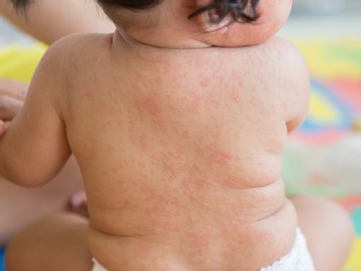 新生兒常見的「玫瑰疹」很可怕嗎？好發年齡、症狀與預防照護一次看 - The News Lens 關鍵評論網