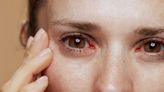 Dry eye awareness month: 8 Ayurvedic remedies to prevent dry eye syndrome