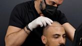 Hair transplant in Turkey: What makes it a top choice?