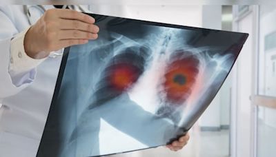 Most lung cancer patients in India non-smokers, decade younger than those in West: Lancet studyg - CNBC TV18