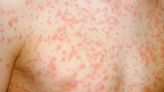 Three early warning signs of measles to look out for in your children as infections rise