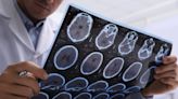 Alzheimer: descubren que los tests de sangre lo detectan con 90% de precisión