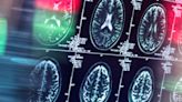 Northwestern brain cancer ultrasound trial yields results