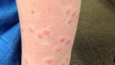 Swimmer's itch rash from Michigan bodies of water: Treatment, prevention information