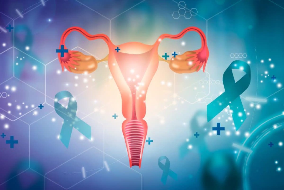 Endometriosis linked to much higher odds of ovarian cancer