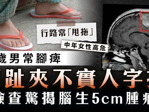 腦瘤惹禍｜32歲男常腳痺腳趾夾不實人字拖 檢查驚揭腦生5cm腫瘤