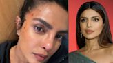 Priyanka Chopra Gets Injured on Heads of State Set, Shares Photo Of Bloodied Forehead | See Here - News18