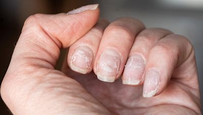 ¿Tus uñas tienen manchas, rayas o se rompen? Esto es lo que significa