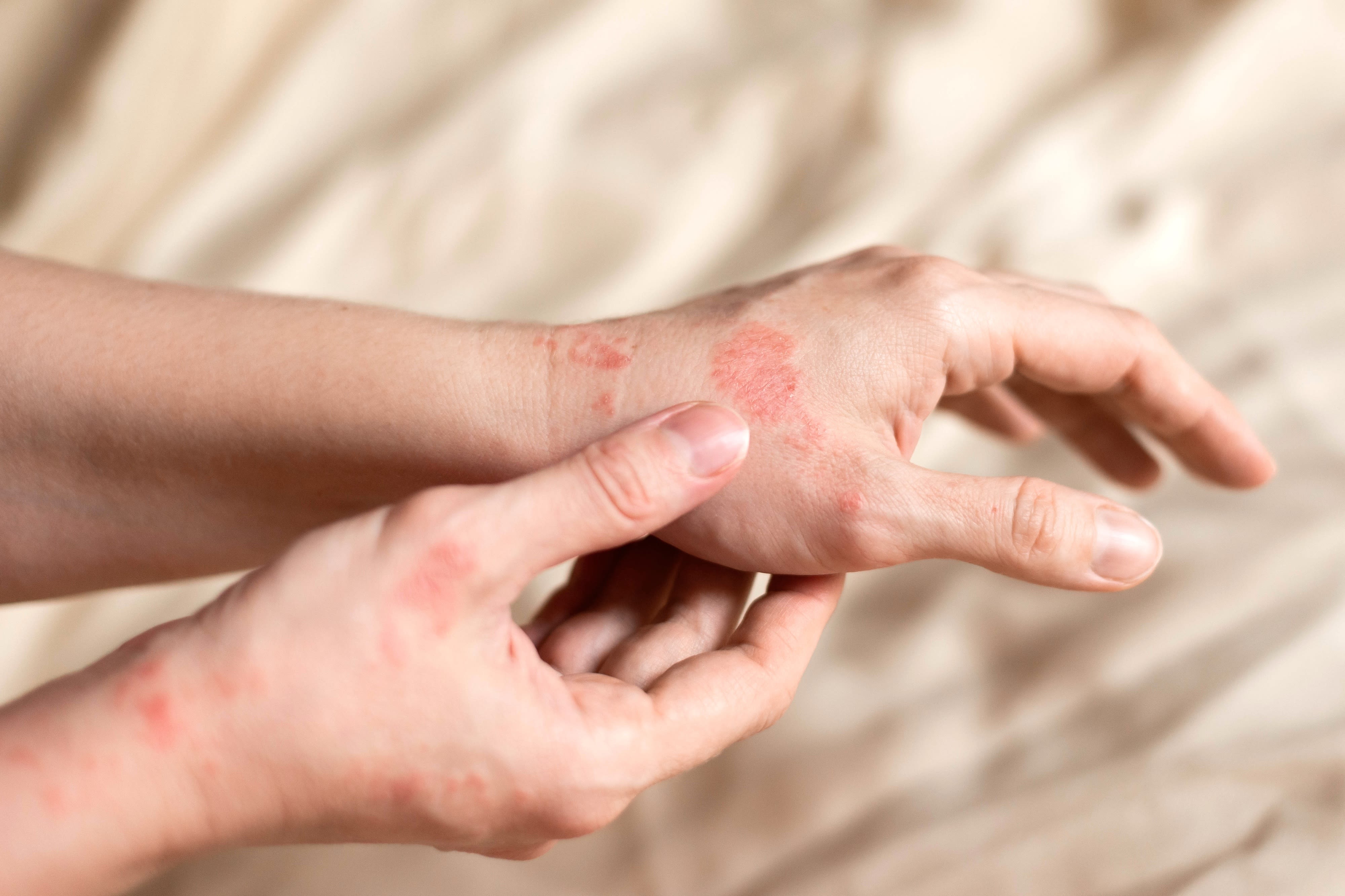 A salty diet may increase eczema in adults, study finds