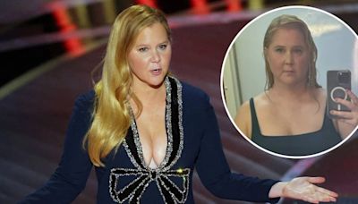 Amy Schumer habló sobre su “rostro hinchado” y su diagnóstico de Síndrome de Cushing