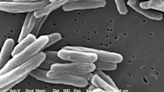 US tuberculosis cases were at the highest level in a decade in 2023