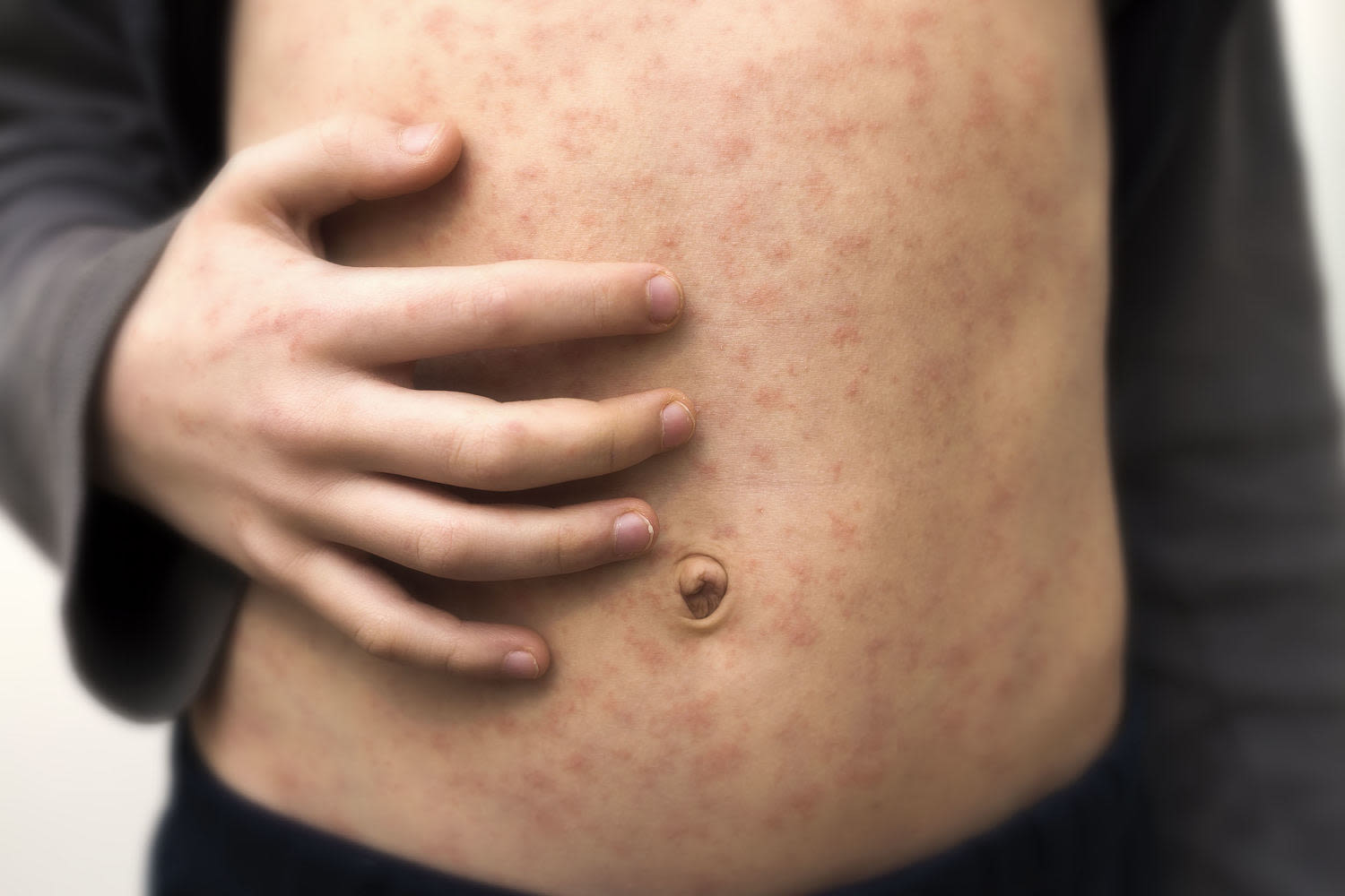 Measles cases have been reported in 19 states this year. What does a measles rash look like?