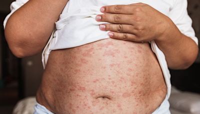 Stomach Rash: Causes and Treatments