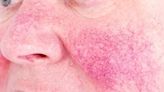 Dermatologist recommendations for controlling rosacea