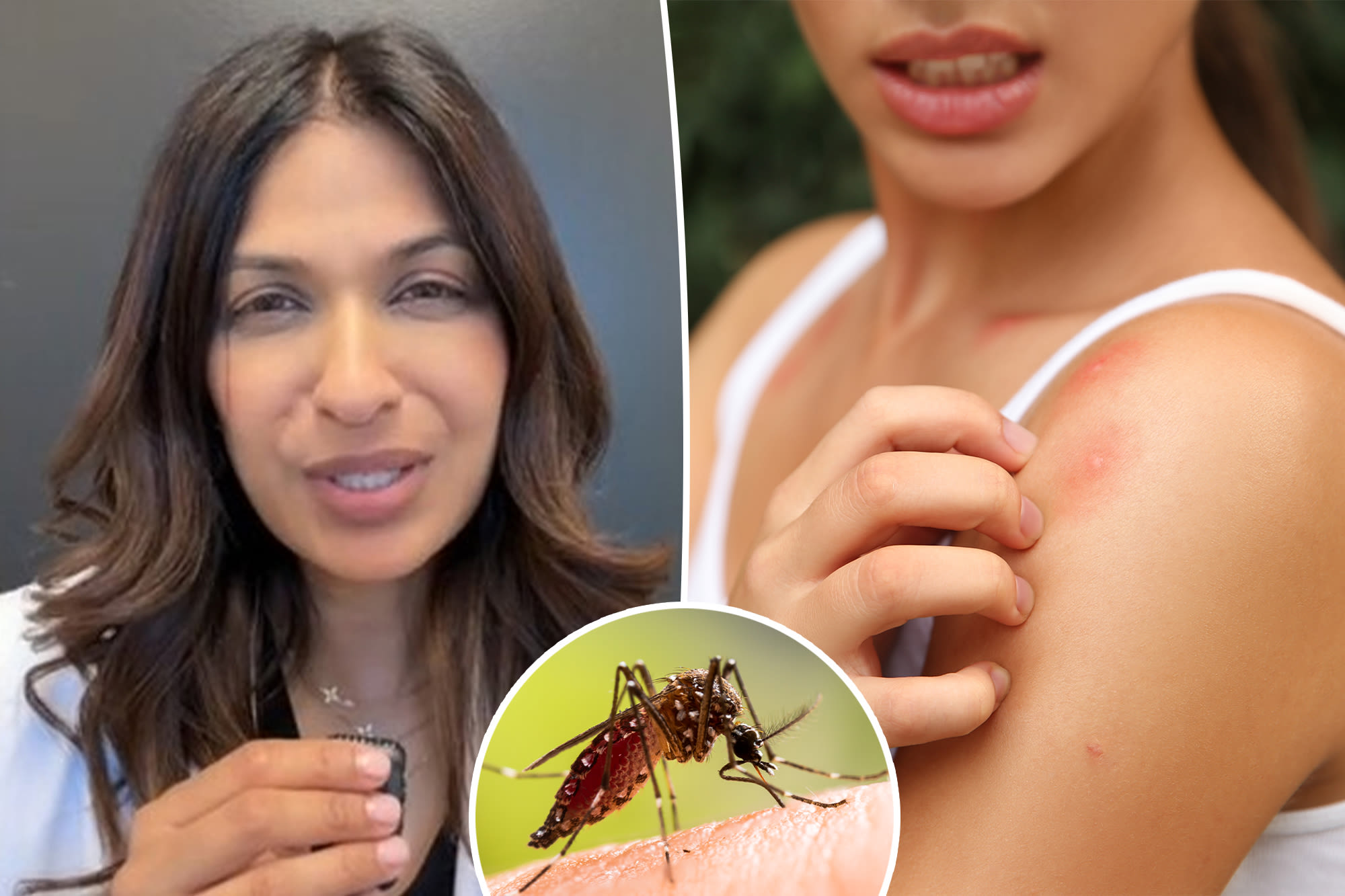 I’m a doctor — this is the easiest way to heal mosquito bites fast