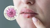 New herpes study reveals 'significant' information