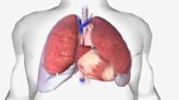 Pleural Dynamics treats first patient with pleural effusion device