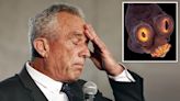 RFK Jr. said doctors found a dead worm in his head after it ate part of his brain
