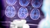 Government to launch $300M Alzheimer’s research database