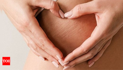 Stretch Marks Home Remedies: Best home remedies to get rid of stretch marks | - Times of India