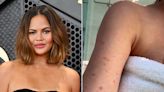 Chrissy Teigen Reveals She Burned Her Arm Cooking During 2024 Super Bowl: ‘This Is Not a Rash’