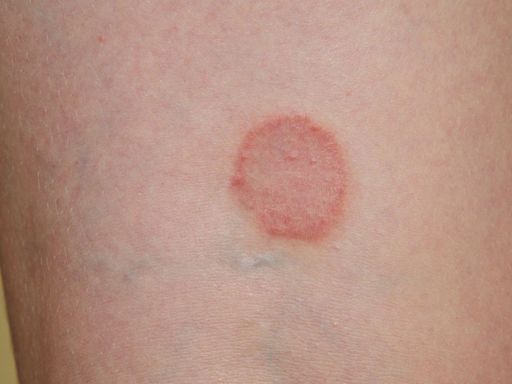 1st case of hard to kill sexually-transmitted ringworm reported in US