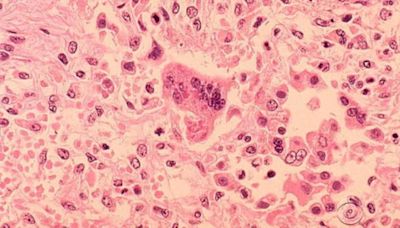 Siblings with measles could have exposed others at HCMC, state health department says