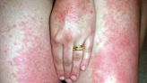 Tanning Bed Rash: How to Identify and Treat It