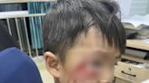 河南3歲男童被狗咬打針後仍死亡 狂犬病疫苗遭質疑