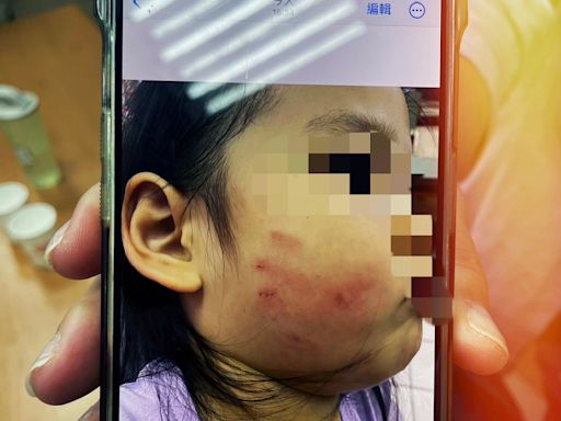 桃園準公幼傳兒虐！3歲女童午休不睡覺遭教保員施暴「臉浮巴掌痕」