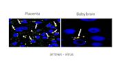 In rare cases COVID-19 can cross placenta, causing fetal brain damage, UM study says