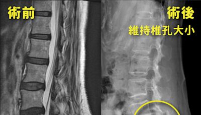 竹科女長期久坐 椎間盤突出痠痛麻無力 - 自由健康網