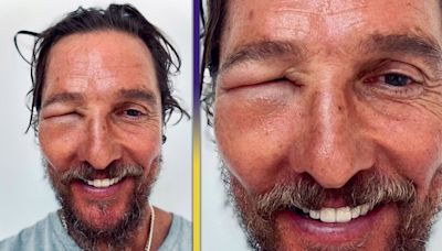 Matthew McConaughey Shows Off Wild Bee Sting Swelling