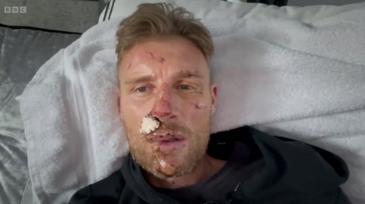 Freddie Flintoff reveals full facial injuries in tearful home video after Top Gear crash