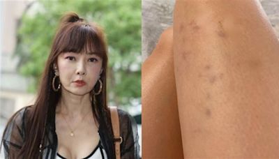 58歲美魔女突曬大腿紅腫照！曝「剛才被打到瘀青」 瘋狂動手畫面流出