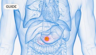 Pancreatic cancer: Symptoms, causes and treatment