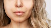 'Buccal fat removal': Who decided round cheeks were something to be insecure about?
