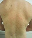 Pityriasis rosea