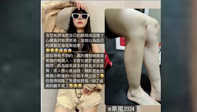 「姐姐」謝金燕美腿腫成象腿驚嚇爆哭！醫：小心腎、肝、心等器官問題