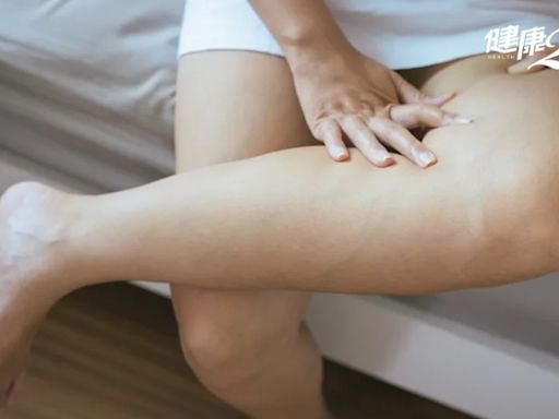 小腿為何老是腫起來？醫解析小腿腫4大原因 這些抗水腫對策快學起來