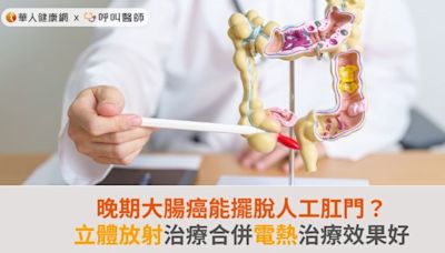 晚期大腸癌能擺脫人工肛門？立體放射治療合併電熱治療效果好 | 蕃新聞