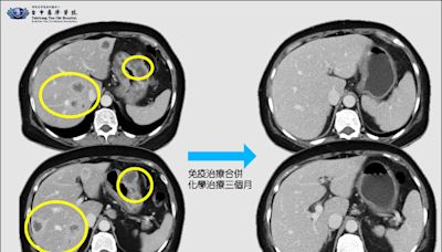 胃癌4期轉移肝臟 免疫治療合併化療治癒 - 自由健康網