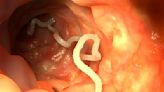 What Is a Tapeworm Infection?