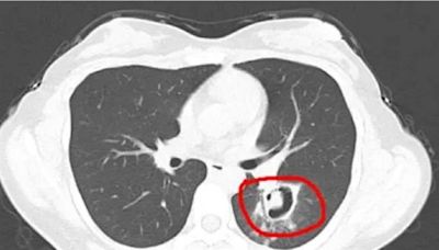 她肺部長「小樹芽」竟是發霉了！醫化驗秒懂：1動作害的