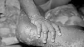 The symptoms and causes of monkeypox infections, which CDC calls an ‘emerging issue’