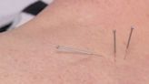 Acupuncture as complementary care can ease pain, side effects of cancer medications