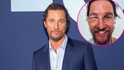 Matthew McConaughey’s Eye Is Swollen Shut After Bee Sting: ‘Bee Swell’