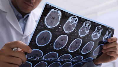 Alzheimer: ofrecen pruebas sanguíneas para detectar la enfermedad que pueden tener hasta un 90% de precisión