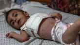 Dangerous Skin Diseases Spreading Among Malnourished Children In Gaza