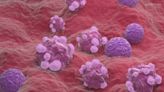 Seattle researchers explore causes of ovarian cancer: HealthLink